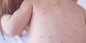 Know signs of chickenpox and scarlet fever this winter